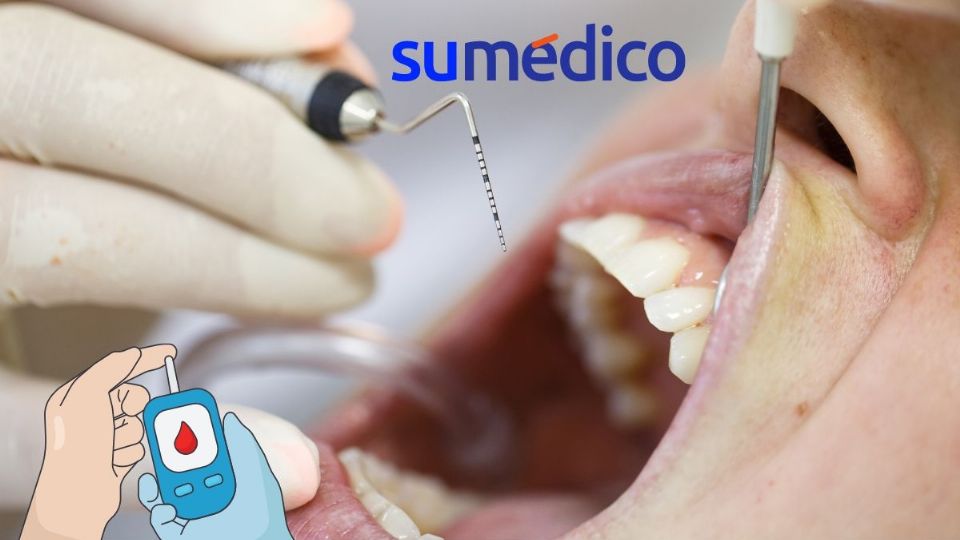 ¿Cuidas tus dientes? Este estudio relaciona la periodontitis avanzada con diabetes.