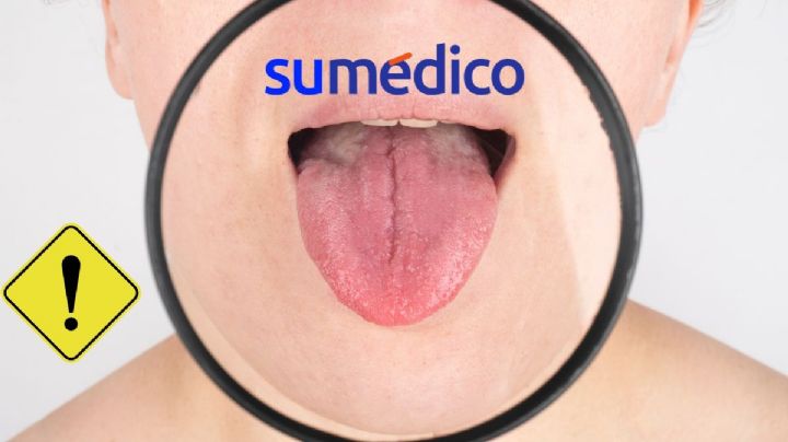 Las 3 prácticas que podrían incidir en el desarrollo de cáncer en la cavidad oral, según IMSS