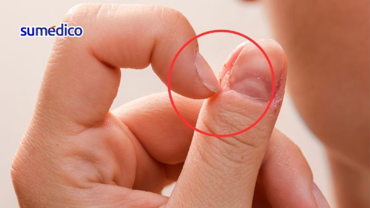 ¿Por qué salen padrastros en las uñas y qué hacer si se infectan?