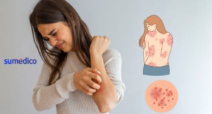 ¿Qué es la psoriasis y cómo afecta a la vida diaria de las personas?