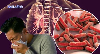 ¿Qué síntomas da la tuberculosis? Es la enfermedad infecciosa más mortífera