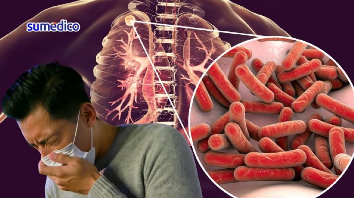 ¿Qué síntomas da la tuberculosis? Es la enfermedad infecciosa más mortífera
