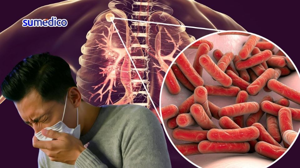 Los síntomas de la tuberculosis son graves.