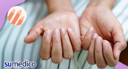 ¿Qué significan las rayas en las uñas? Pueden ser síntomas de estas enfermedades