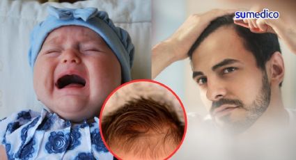 Síndrome del hombre lobo en bebés; uso de minoxidil de los padres podría influir