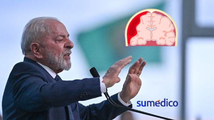 ¿Qué es la hemorragia intracraneal que sufrió Lula Da Silva?