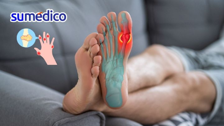 Qué es la gota y cómo evitar que te dé en Navidad
