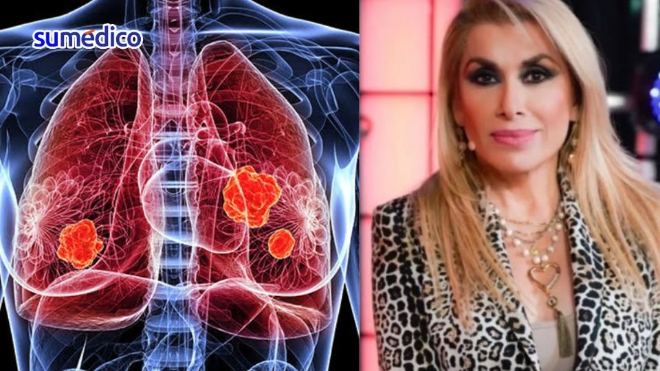 Un amigo de la cantante confirmó que Dulce tuvo un tumor pulmonar.