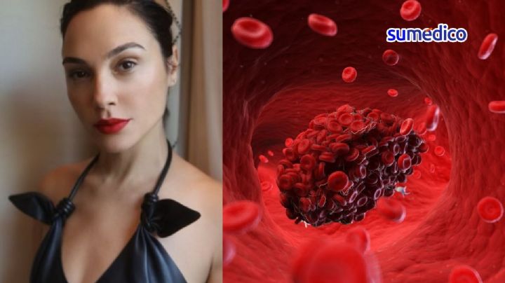 ¿Qué síntomas da un coágulo cerebral en el embarazo como el que tuvo Gal Gadot?
