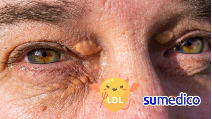 ¿Cómo se ve el colesterol alto en los ojos?