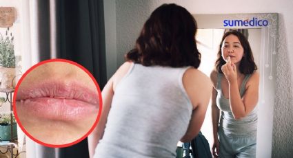 ¿Por qué tengo los labios resecos? 5 enfermedades que podrían ocultarse