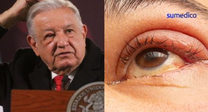 ¿Por qué a AMLO no se le quita el "tutupiche" u orzuelo del ojo?