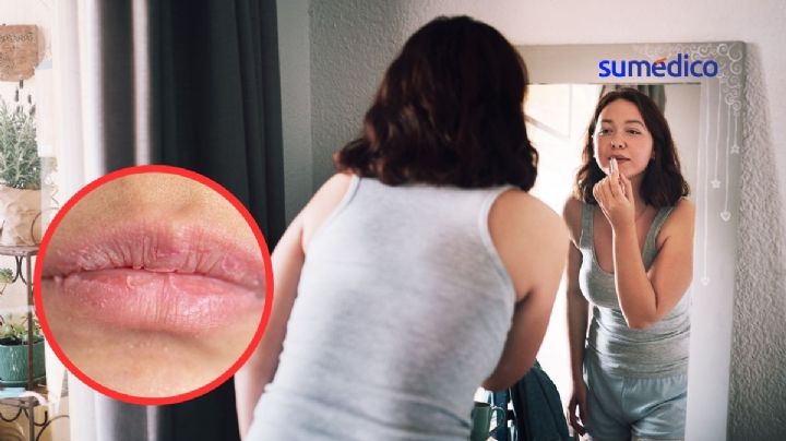 ¿Por qué tengo los labios resecos? 5 enfermedades que podrían ocultarse