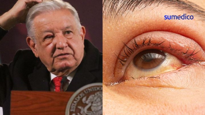 ¿Por qué a AMLO no se le quita el "tutupiche" u orzuelo del ojo?