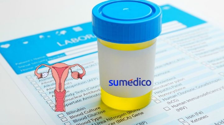 ¿El cáncer de ovario se puede detectar a través de una prueba de orina?