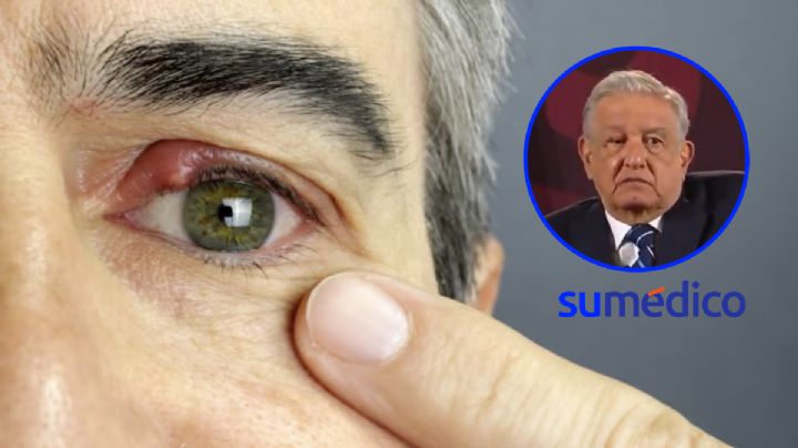 AMLO trata su tutupiche u orzuelo con paños calientes ¿es adecuado?