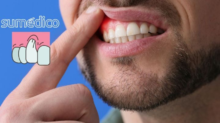 ¿Qué hacer cuando las encías se retraen? Las causas de este problema de encías