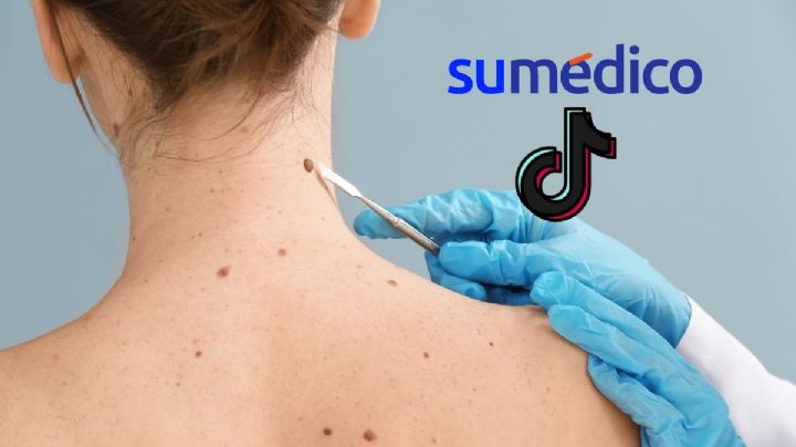 Joven de 26 años detecta cáncer de piel por truco de belleza viral en TikTok