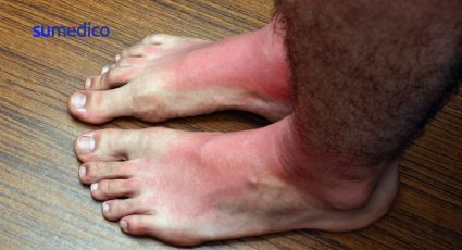 5 razones por las que te arden los pies