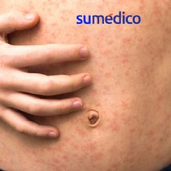 Sarampión: 3 veces más contagioso que COVID-19, advierte experto