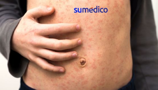 Sarampión: 3 veces más contagioso que COVID-19, advierte experto