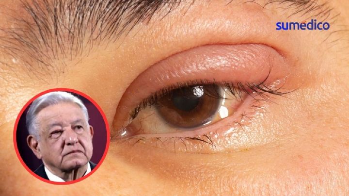 ¿Qué es un “tutupiche” u orzuelo en el ojo como el que tiene AMLO?