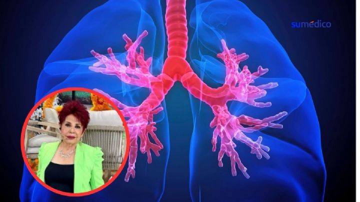 ¿Qué es el tromboembolismo pulmonar qué padece Ema Pulido?