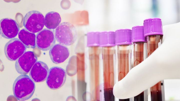 Leucemia: ¿cómo ayuda la medicina personalizada?