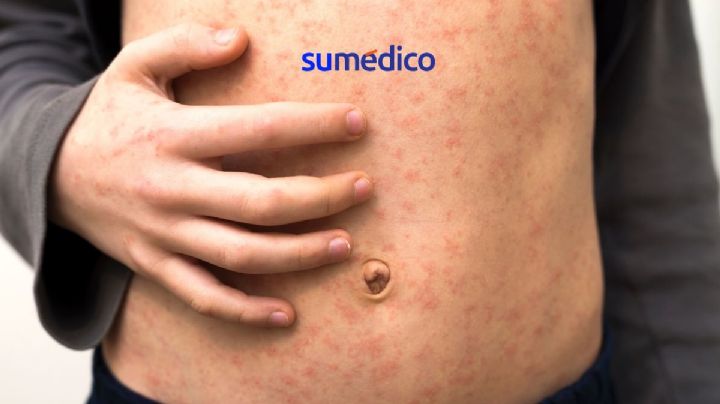 ¿Cómo se contagia el sarampión y cuáles son los síntomas?
