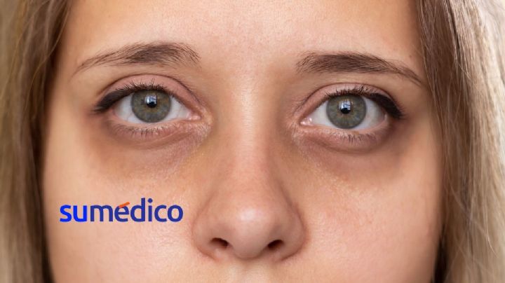 ¿Cómo deshacerse de las bolsas bajo los ojos? Conoce estos consejos