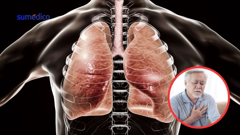 La hipertensión arterial pulmonar afecta a 1 % de la población mundial.