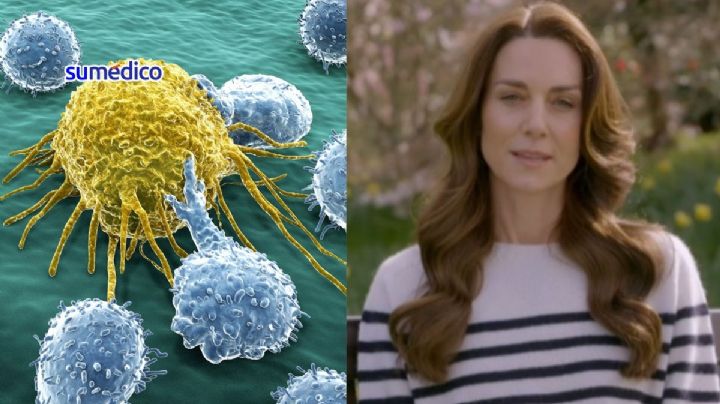Mujer encontró que tenía cáncer después de una cirugía abdominal, como Kate Middleton