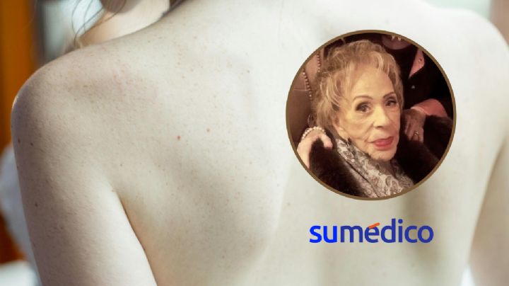 ¿Cómo evitar las llagas como las que tiene Silvia Pinal?