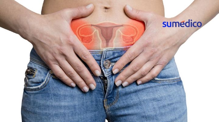 ¿Cuáles son los síntomas que avisan sobre el cáncer de ovario?