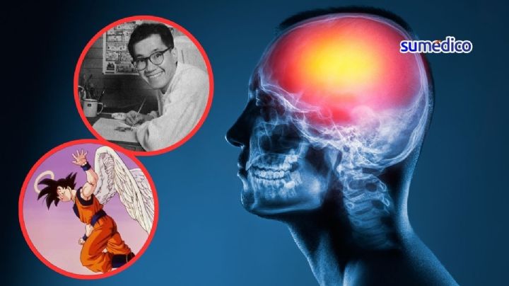 ¿Qué es un hematoma subdural como el que causó la muerte de Akira Toriyama, creador de Dragon Ball?