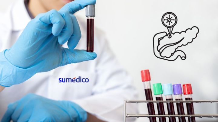 El análisis de sangre que podría cambiar todo respecto al cáncer de páncreas