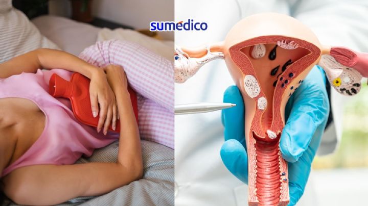 “Tenemos que dejar de normalizar el dolor menstrual”: Ginecólogo explica la adenomiosis