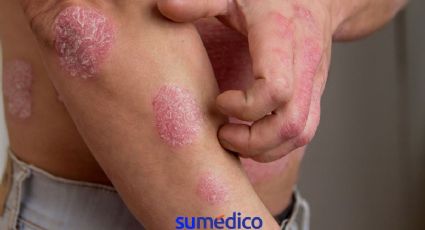 ¿Tienes psoriasis? 5 consejos que debes seguir