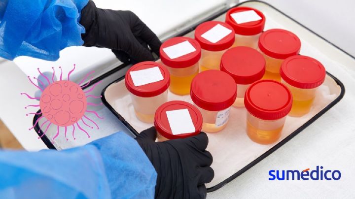 ¿Cuáles son los tipos de cáncer qué se pueden detectar a través de una prueba de orina?