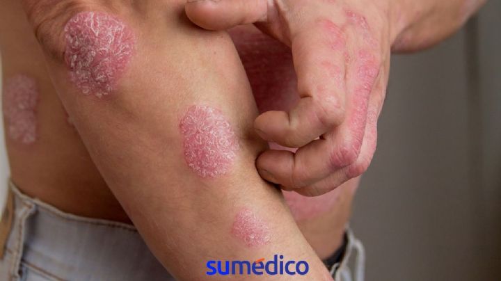 ¿Tienes psoriasis? 5 consejos que debes seguir