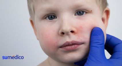 Enfermedad de la bofetada: Es común en niños y se activa con el calor ¿Cómo detectarla?