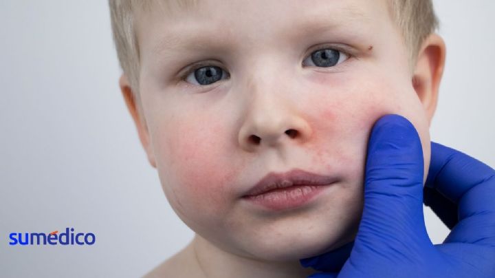 Enfermedad de la bofetada: Es común en niños y se activa con el calor ¿Cómo detectarla?
