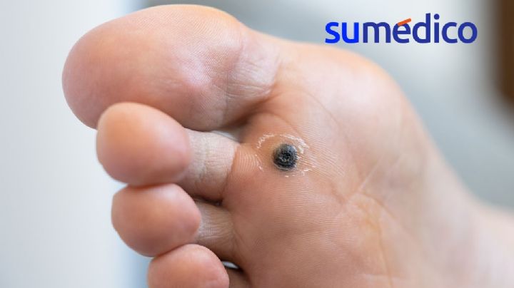 ¿Cómo se quita el ojo de pescado en los pies?