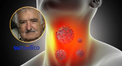 ¿Cuáles son los factores de riesgo del tumor de esófago como el que le detectaron a José Mujica?