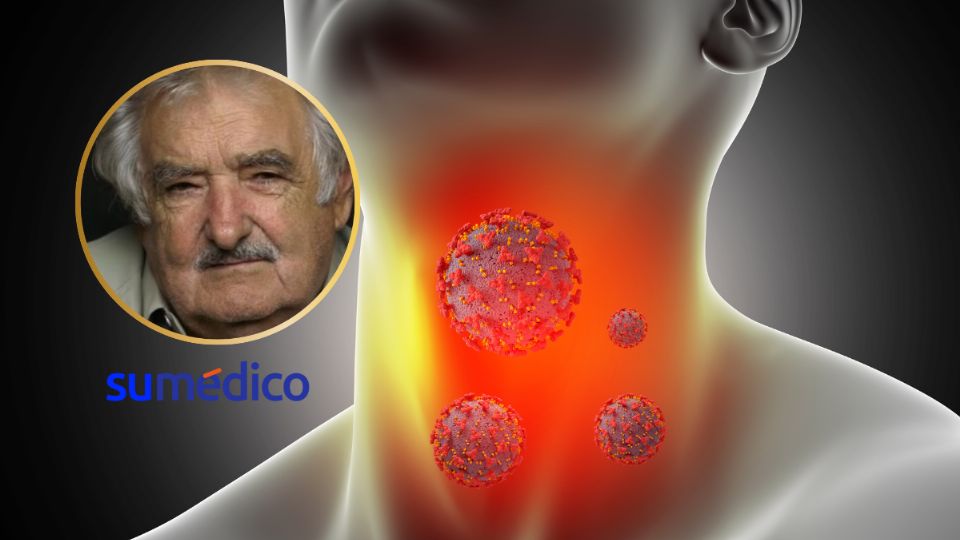 El cáncer de garganta es más frecuente en hombres