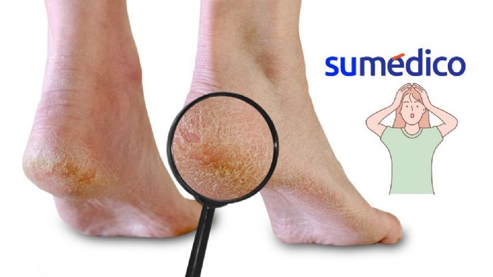 ¿Cómo eliminar las grietas en los talones? 3 trucos que te ayudarán