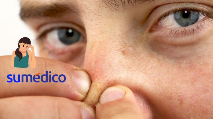 ¿Cómo quitar los puntos negros de la nariz? 5 remedios caseros