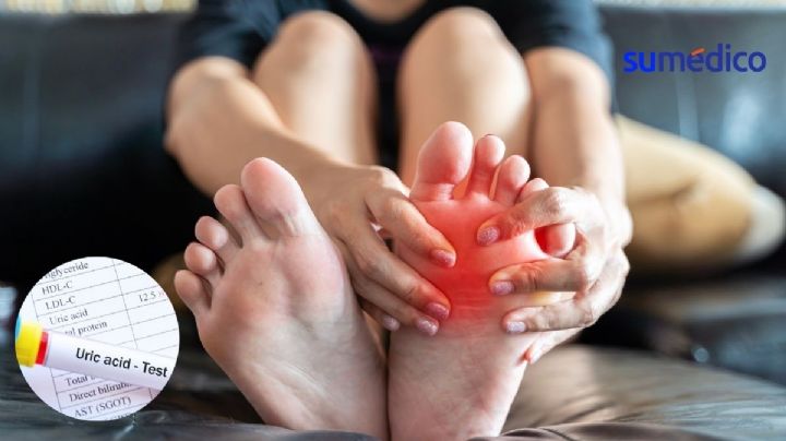 ¿Qué es el ácido úrico y cómo bajar sus niveles en el cuerpo?