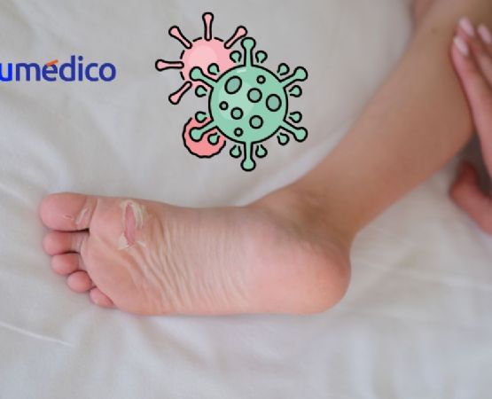 ¿Qué es el virus Coxsackie, cómo se manifiesta y por qué causa alerta?