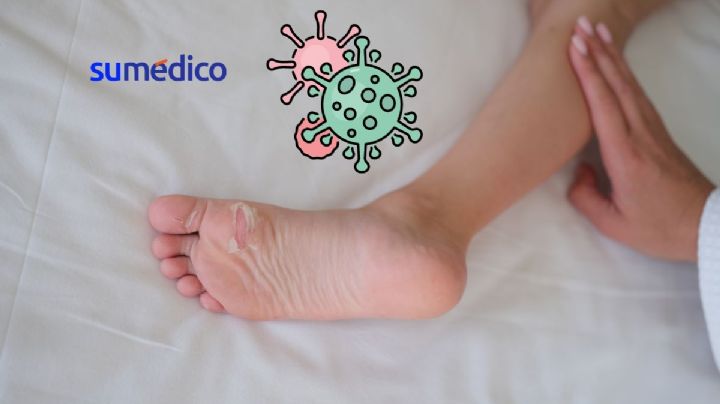 ¿Qué es el virus Coxsackie, cómo se manifiesta y por qué causa alerta?